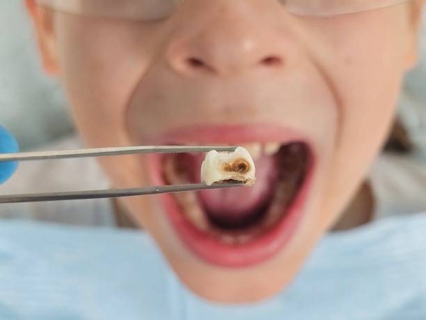 Best Chipped Tooth Repair Near Me  in Pine Bush, NY